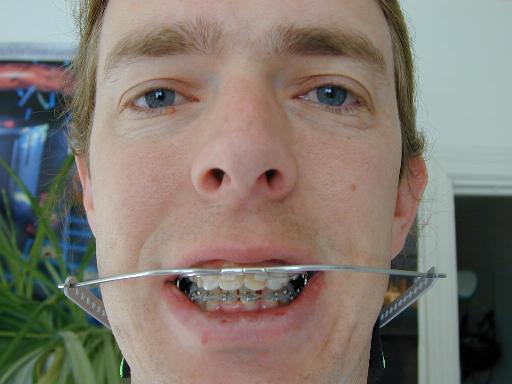 braces-2003-05-29.jpg